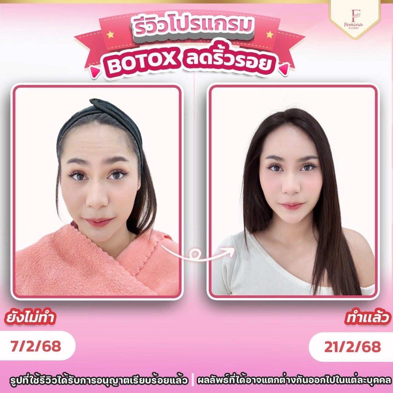 รีวิวโปรแกรมโบท็อกซ์ลดริ้วรอย