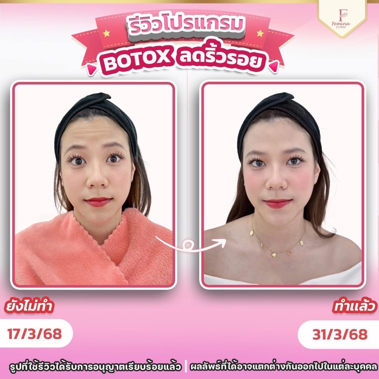 รีวิวโปรแกรมโบท็อกซ์