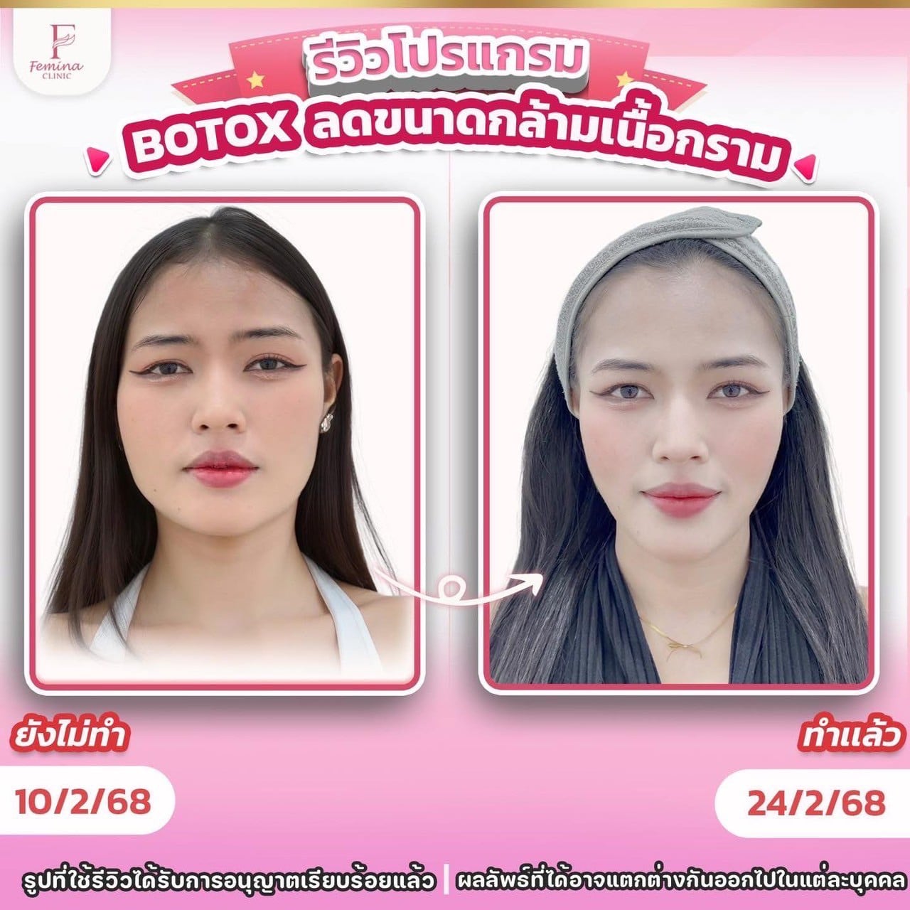 โบท็อกซ์ลดกล้ามเนื้อกราม