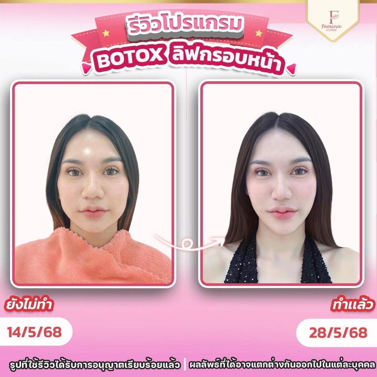 โบท็อกซ์ลิฟกรอบหน้า