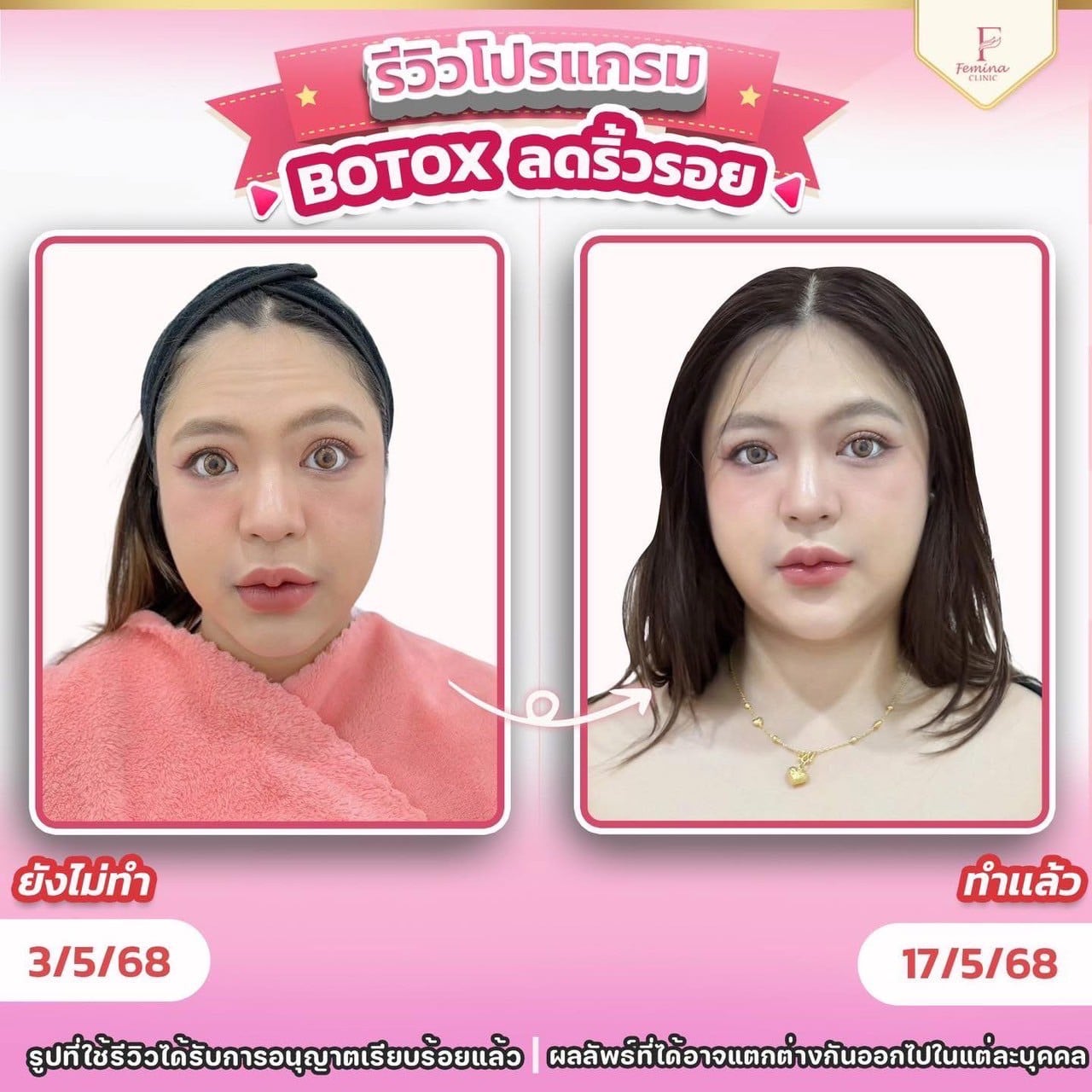 โบท็อกซ์ลดริ้วรอย