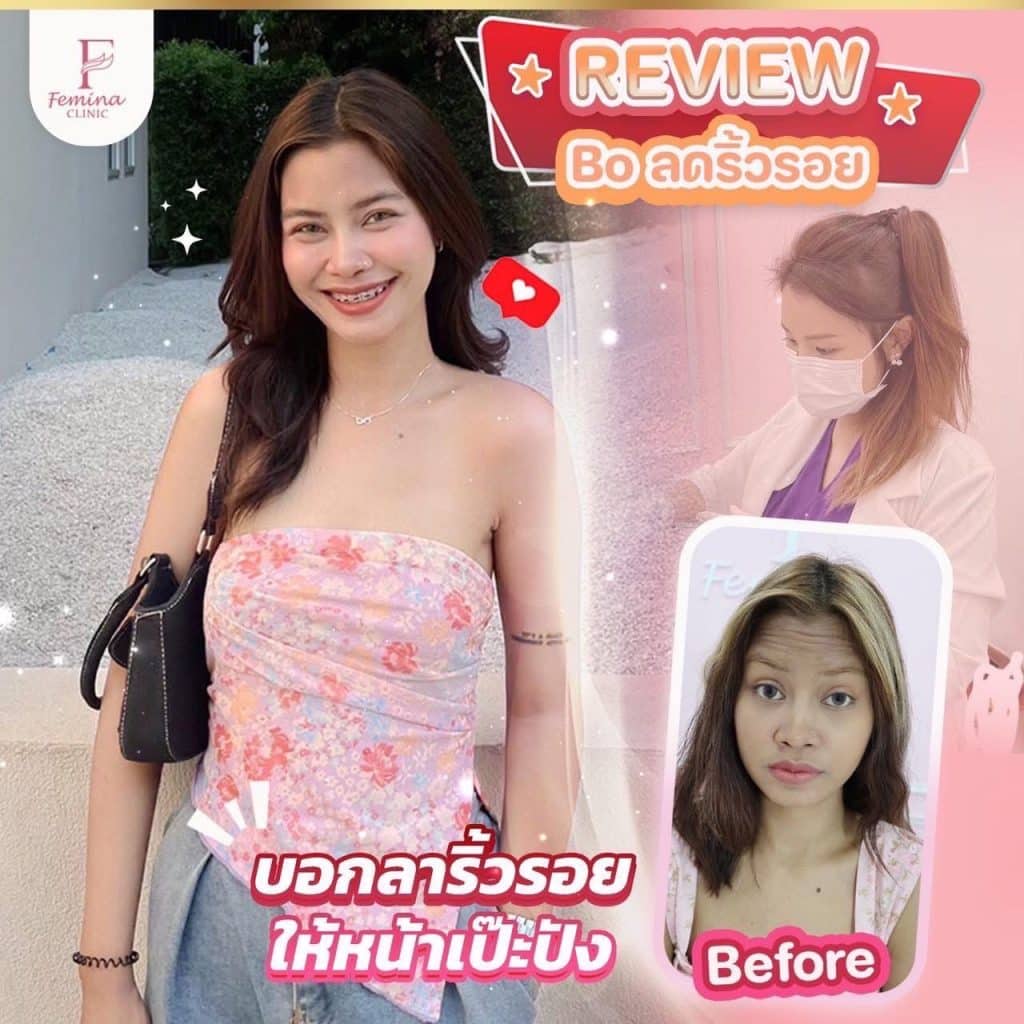รีวิวโบลดริ้วรอย