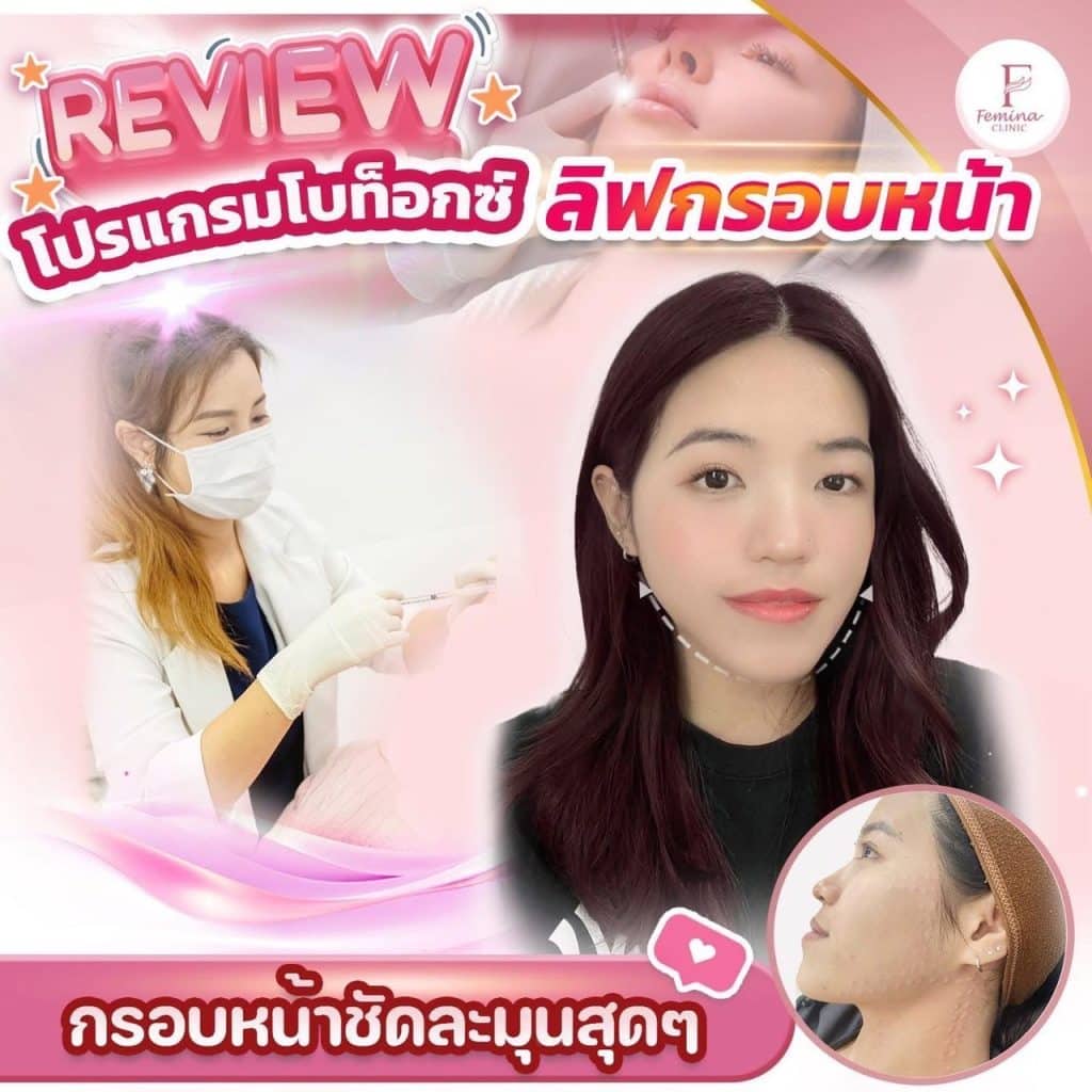 รีวิวโบท็อกซ์ลิฟกรอบหน้า