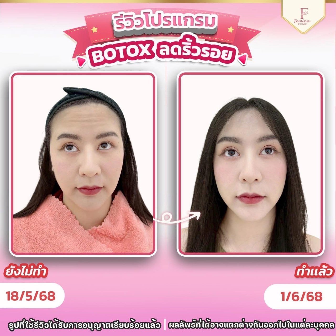 โบท็อกซ์ลดริ้วรอย