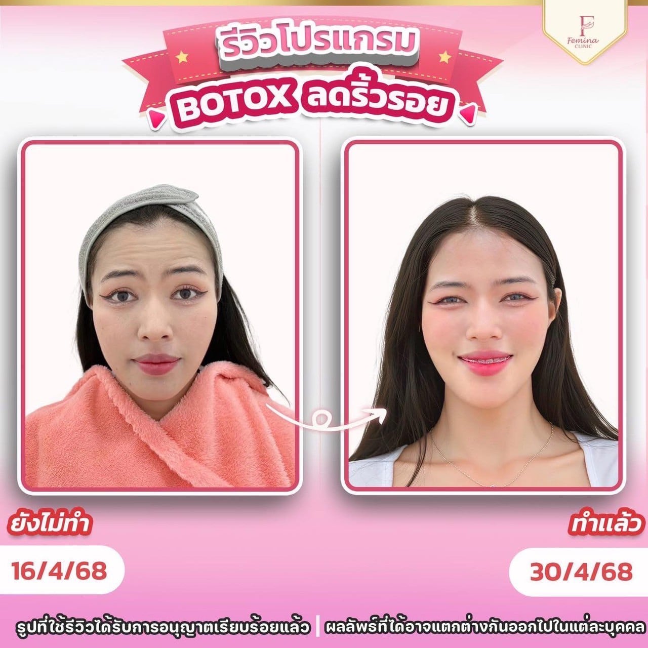 รีวิวโปรแกรมโบท็อกซ์
