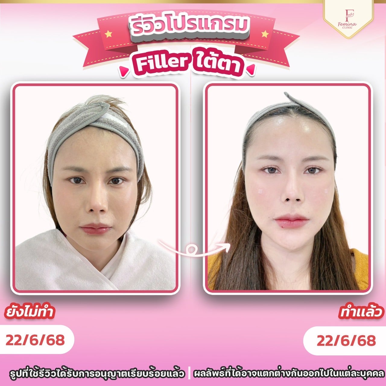 ฟิลเลอใต้ตา