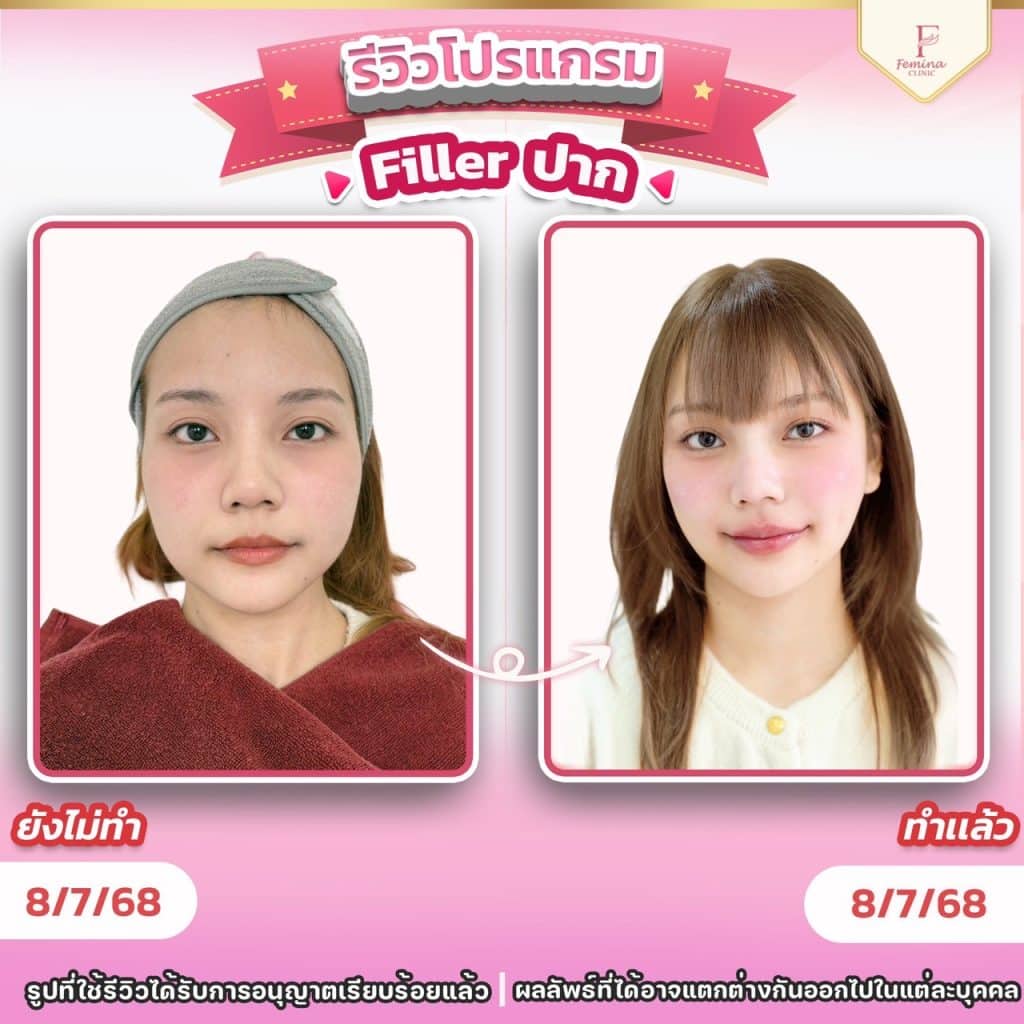รีวิวโปรแกรมฟิลเลอร์ปาก