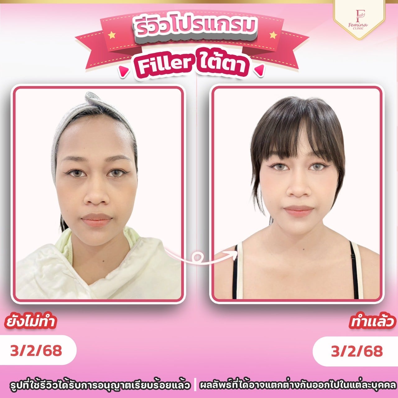 รีวิวโปรแกรมฟิลเลอใต้ตา