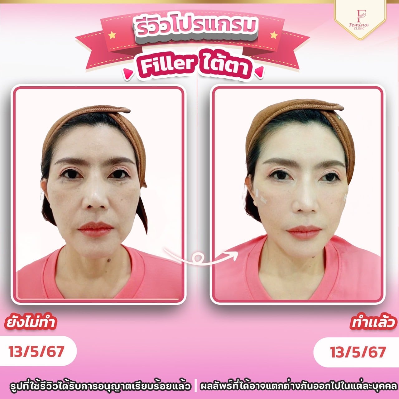 ฟิลเลอใต้ตา