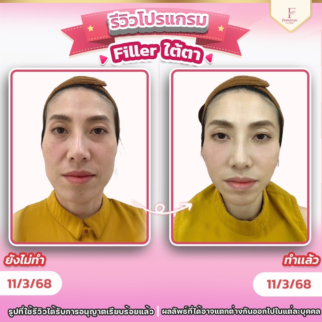 รีวิวโปรแกรมฟิลเลอ