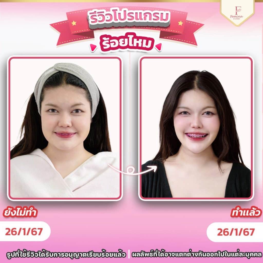 รีวิวโปรแกรมร้อยไหม